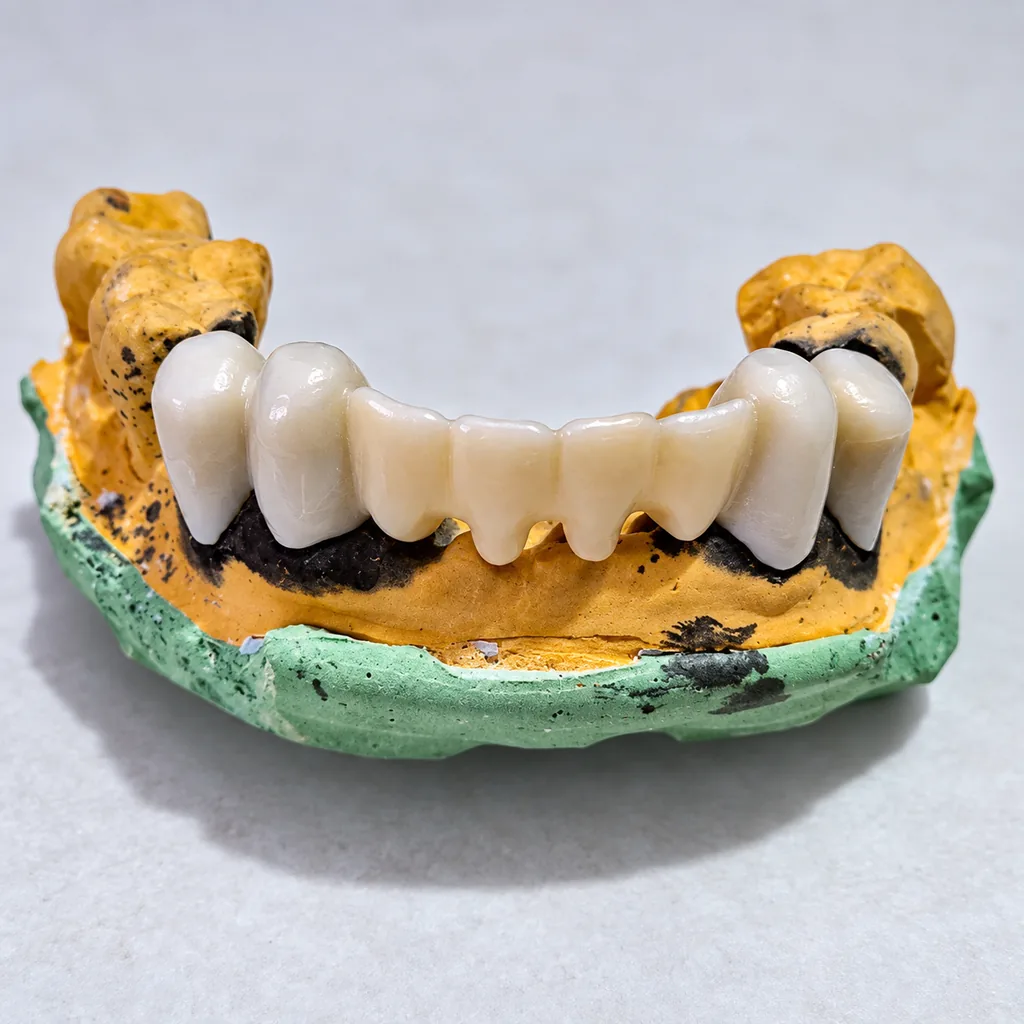 Fixed dental bridge study cast